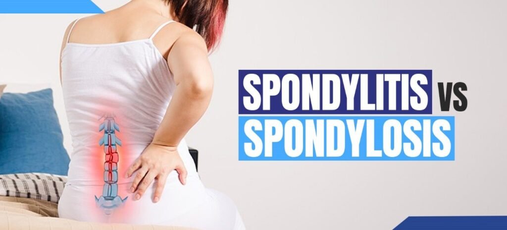 spondylitis vs spondylosis