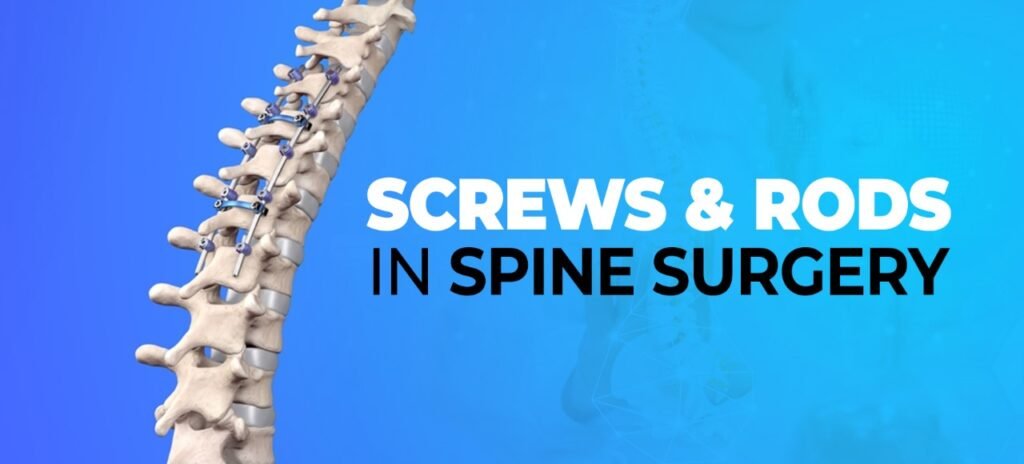 screws and rods in spine surgery